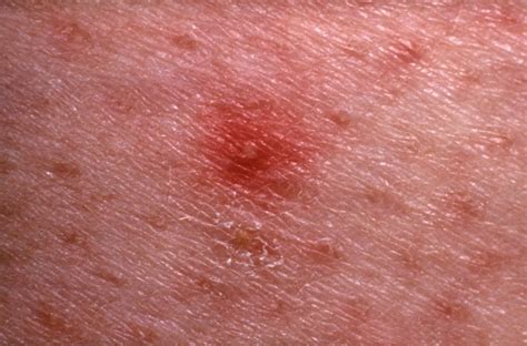 Skin Rash: 7 Causes of Red Spots and Bumps With Pictures | Allure