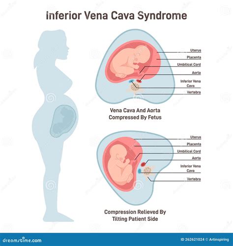 Inferior Vena Cava Syndrome. Pregnant Woman Has A Compression Stock Illustration | CartoonDealer ...