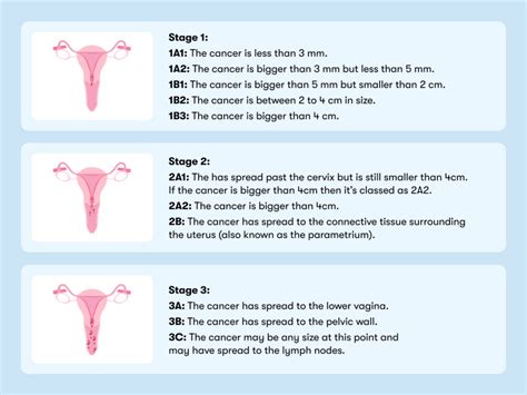 Cervical cancer stages: What to know