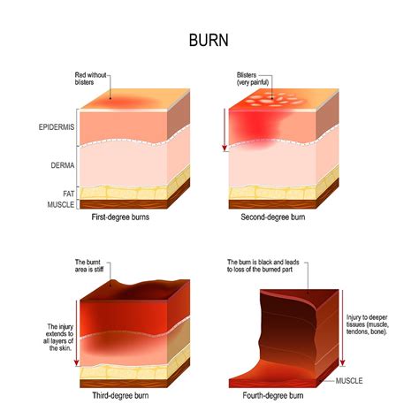 Types of Burn Injuries | Zayed Law Offices Personal Injury Attorneys