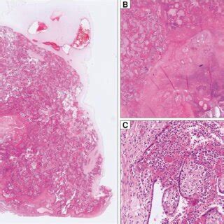 Histological findings of the placenta. A, Overview of a basally ...