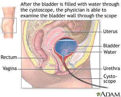 Cystoscopy Information | Mount Sinai - New York