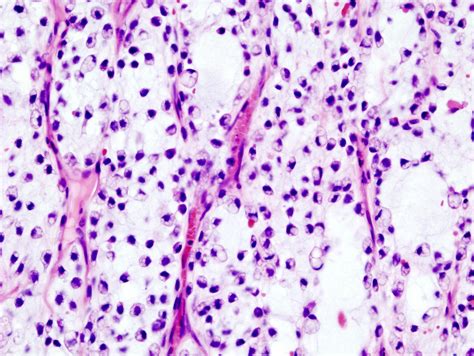 Liposarcoma, Myxoid