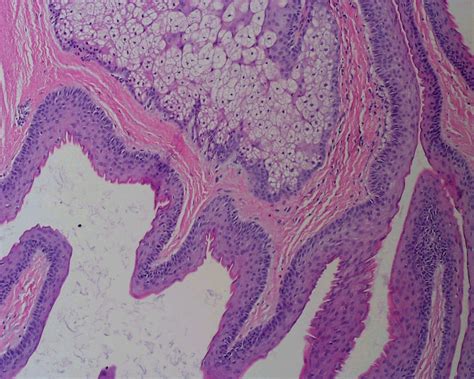 Pathology Outlines - Steatocystoma