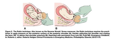 Shoulder Dystocia – Core EM