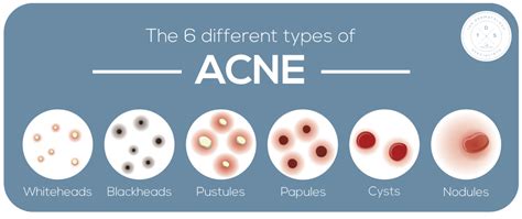 Types Of Acne Nodules