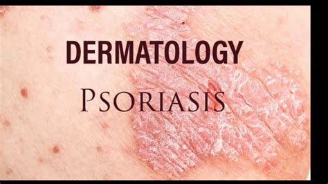 Dermatology - Psoriasis - YouTube