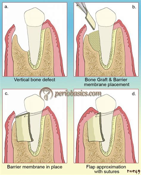 Guided tissue regeneration - periobasics.com