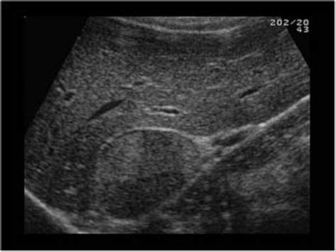 Abdomen and retroperitoneum | 1.10 Adrenal glands : Case 1.10.3 ...