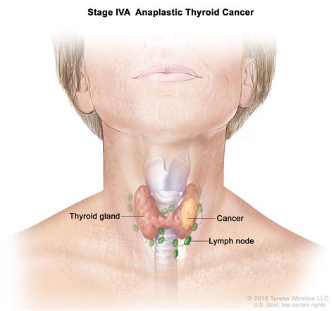 Thyroid Cancer Treatment (Adult) (PDQ®)–Patient Version - National Cancer Institute