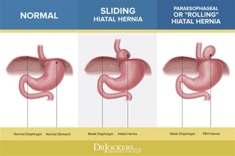 Hiatal Hernia: Symptoms, Causes and Natural Support Strategies