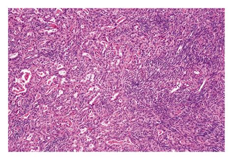 Histology of synovial sarcoma and immunohistochemical staining for ...