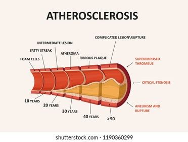 Atherosclerosis Diagram