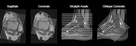 Ankle/Foot MRI