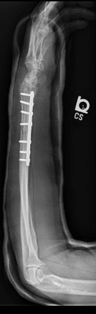 Galeazzi fracture - wikidoc