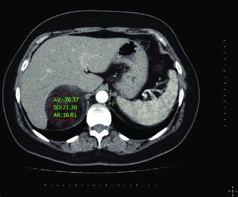 Axial CT image shows well-defined mass in the right adrenal gland with ...