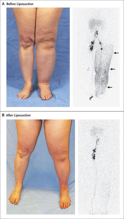 Pin on Lymphedema / Lipedema