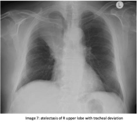 Atelectasis Chest X Ray