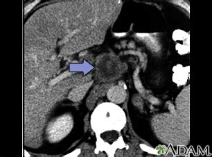 Black Spots On Ct Scan Of Abdomen - splashstory