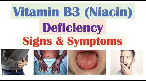 Vitamin B3 (Niacin) Deficiency Signs & Symptoms (Skin, Hair, Gastrointestinal, Psychiatric ...