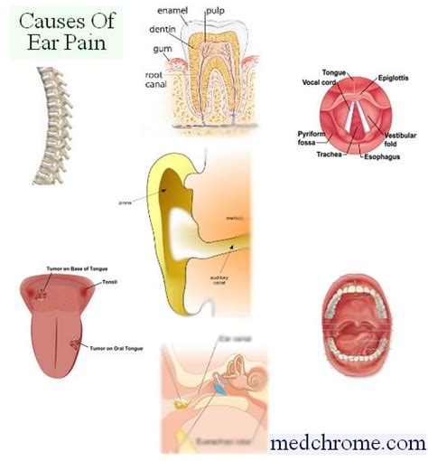 Causes of Earache or Otalgia – Medchrome