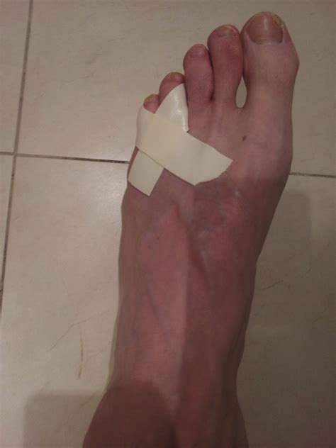 How To Splint, Tape and Heal A Broken Pinkie Toe