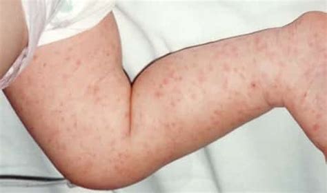 Meningitis Rashes: How to Recognize the Disease (with Pictures)?