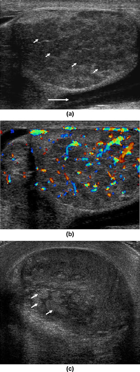 Orchitis. (a) A markedly abnormal testis with pockets of low... | Download Scientific Diagram