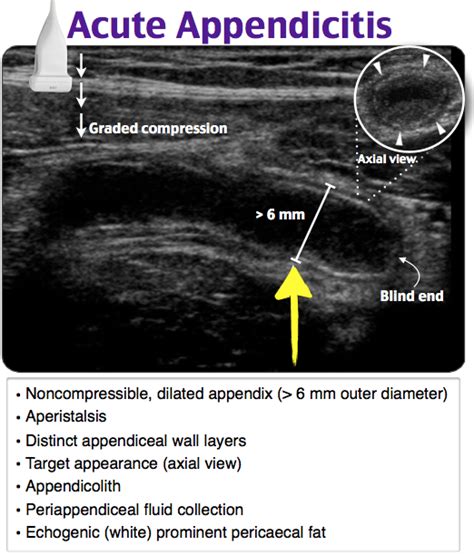 Appendicitis Ultrasound - View more teaching images and get your free trial at RoshReview.com ...