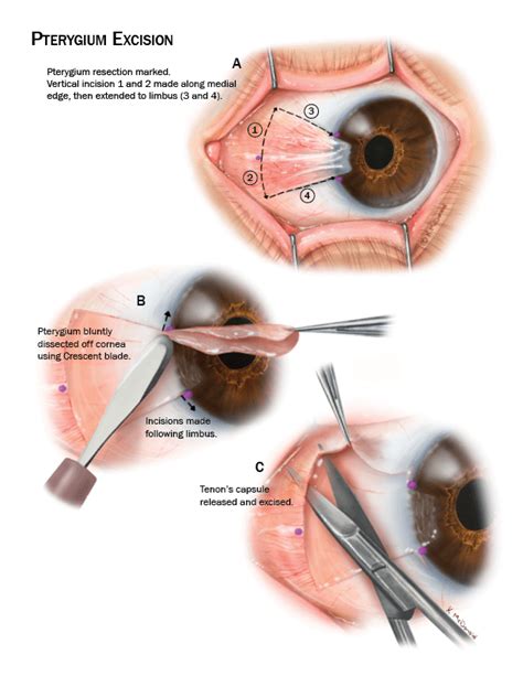 Pterygium Excision – Katelyn McDonald