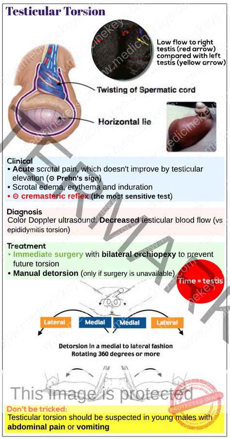 Testicular torsion - Medicine Keys for MRCPs