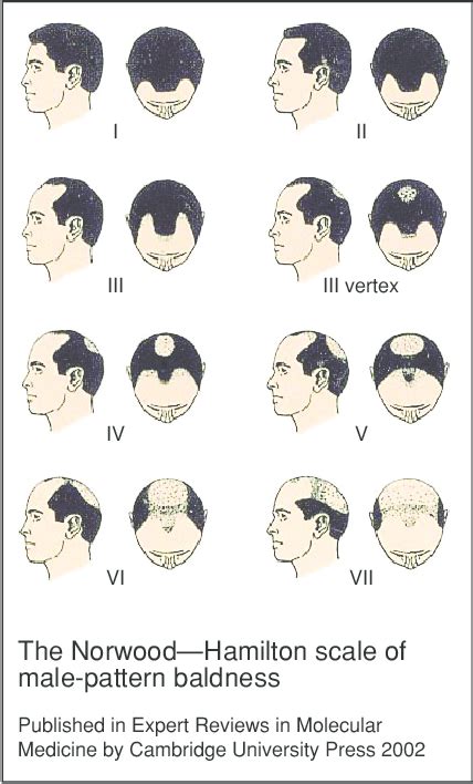 7 Stages of Male Pattern Baldness: Male Balding Patterns 101