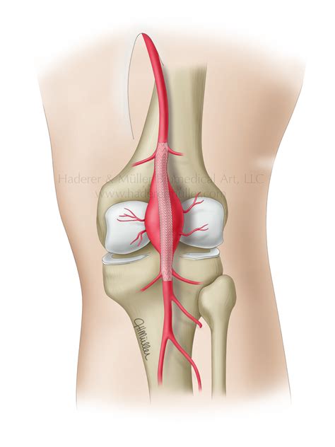 Popliteal aneurysm | HADERER & MULLER