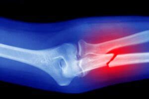 Types of Broken Bones: Treatment, Healing- Dr. Sunny