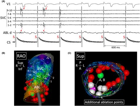 (A) Disappearance of superior vena cava (SVC) potentials (arrows ...