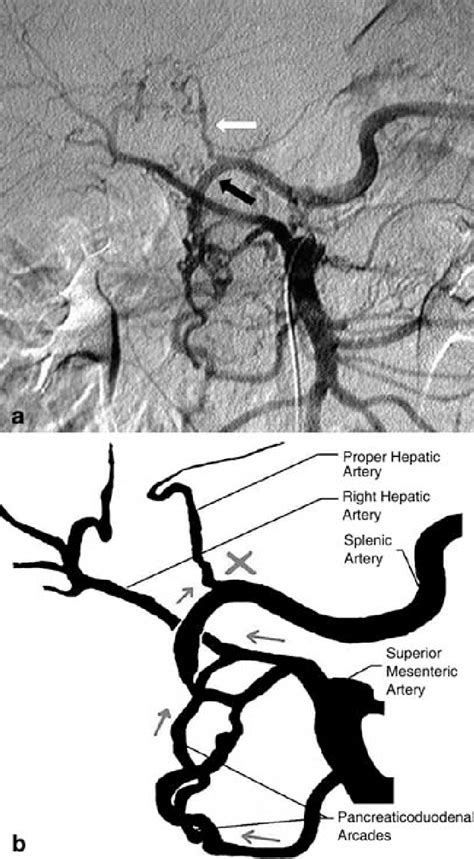 a,b a Mesenteric selective angiography showing celiac trunk compression... | Download High ...