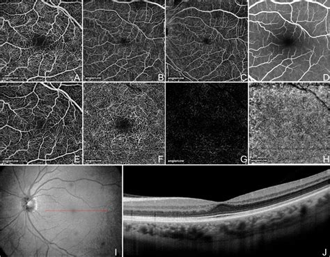 A review of optical coherence tomography angiography (OCTA) | International Journal of Retina ...