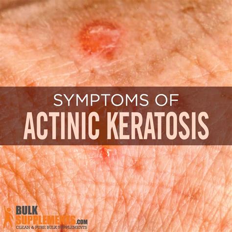 What is Actinic Keratosis: Symptoms, Causes, Treatment