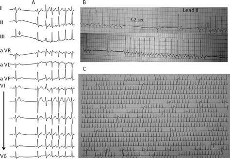 A) 12-lead ECG showing the long RP tachycardia initiated by a sinus... | Download Scientific Diagram