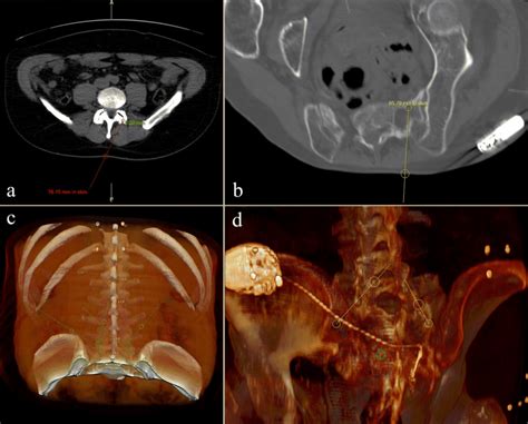 PACS pictures during preoperative planning: a 2D axial image during... | Download Scientific Diagram