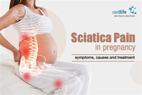 Sciatica Pain In Pregnancy: Symptoms, Causes and Treatment