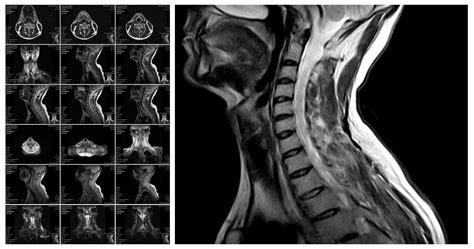 MRI For Assessing Lymph Node Metastasis in Breast Cancer | Docwire News