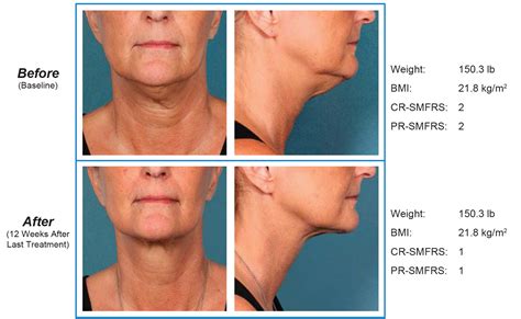 Sodium Deoxycholate (Belkyra™, Kybella®) for Submental Contouring