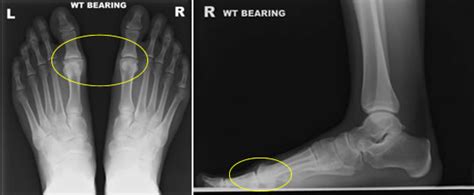 Hallux Rigidus Cheilectomy Surgery | Private Surgeon London | London Foot and Ankle