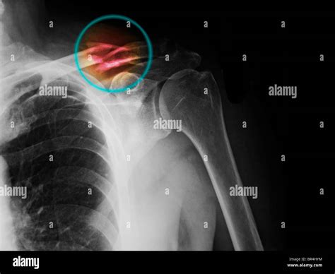 Collarbone x ray hi-res stock photography and images - Alamy