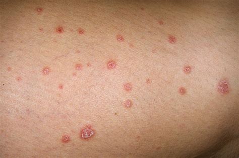 Guttate Psoriasis – Causes, Symptoms & Treatment | Psoriasis expert