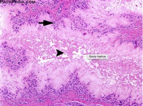 Tophus Histology