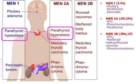 Multiple Endocrine Neoplasia (MEN) Syndrome - Focus Dentistry