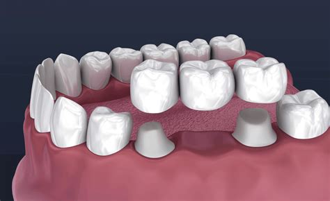 Dental Bridges in SE Calgary | South Trail Crossing Dental near McKenzie Towne