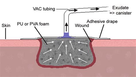 Wound VAC Process, Benefits, Side Effects, Complications,, 45% OFF